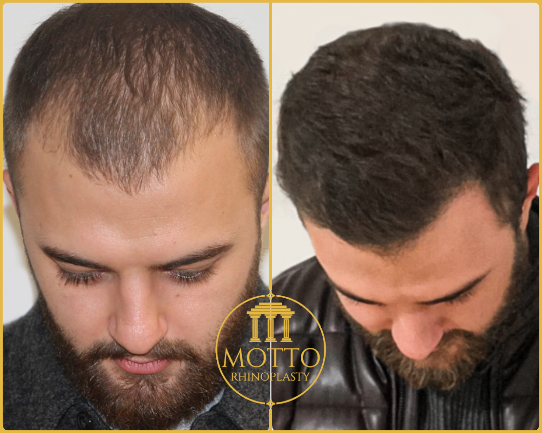 Hair Transplant Before&After – Motto Aesthetic